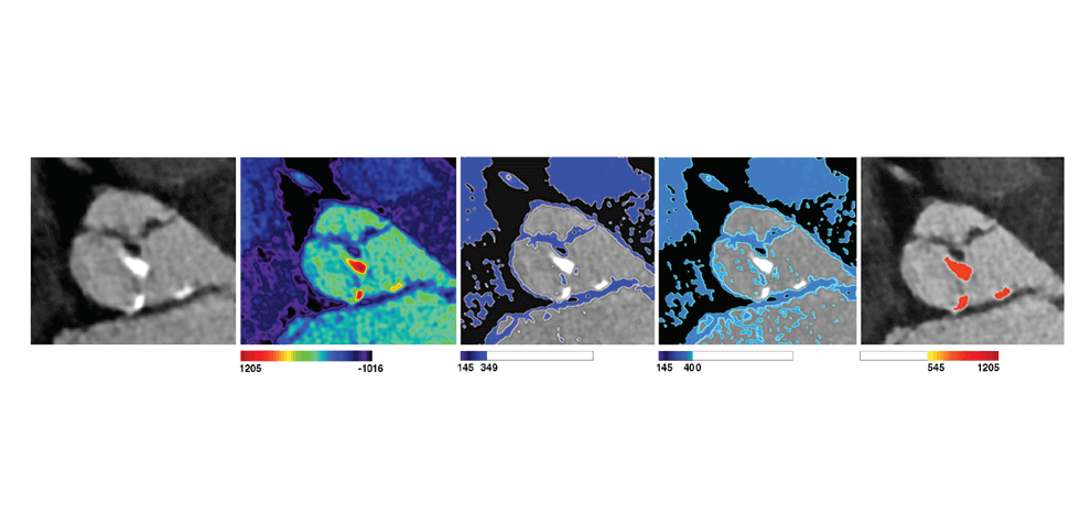 pre-procedural-fit-testing-transcatheter-aortic-valve-replacement-tavr-valves-using-parametric-modeling-3d-printing-2 pre-procedural-fit-testing-transcatheter-aortic-valve-replacement-tavr-valves-using-parametric-modeling-3d-printing-2